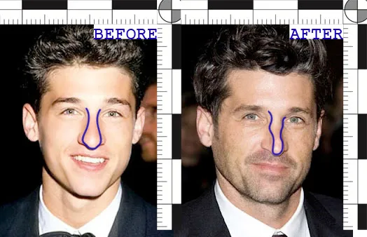 Patrick Dempsey’s before and after nose surgery | Rawnsley Plastic Surgery in Los Angeles, CA