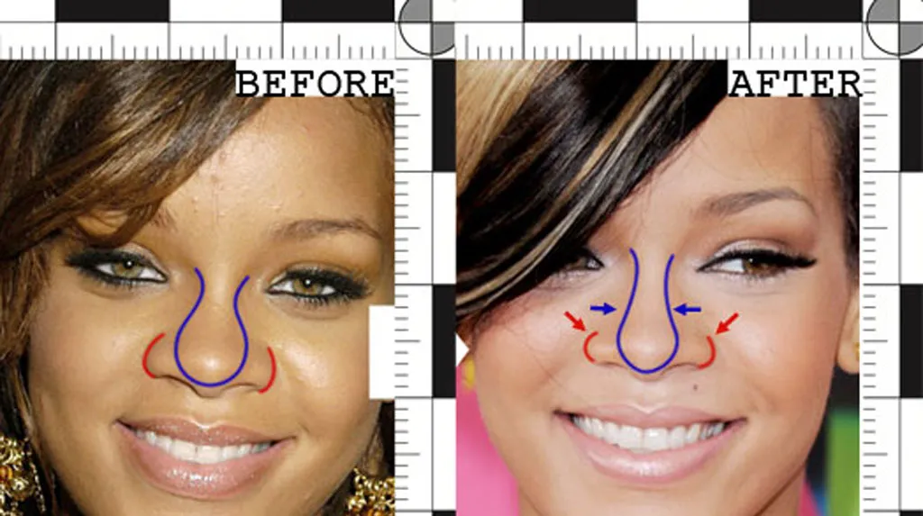 Rihanna's before and after rhinoplasty | Rawnsley Plastic Surgery in Los Angeles, CA