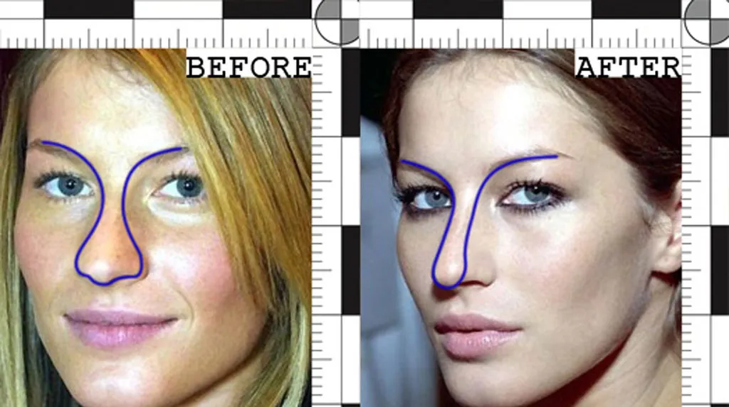 Gisele Bundchen before and after Nose treatment | Rawnsley Plastic Surgery in Los Angeles, CA