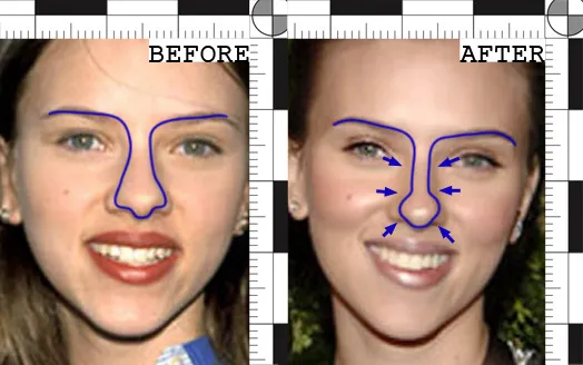 Scarlett Johansson’s before and after Nose treatment | Rawnsley Plastic Surgery in Los Angeles, CA