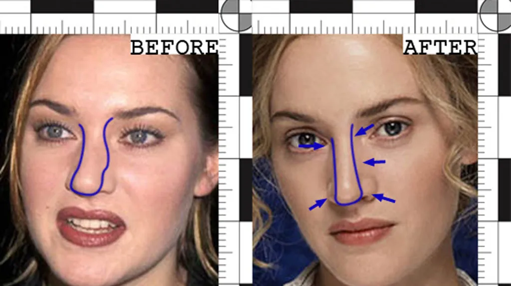 Kate Winslet before and after Rhinoplasty Surgery | Rawnsley Plastic Surgery in Los Angeles, CA