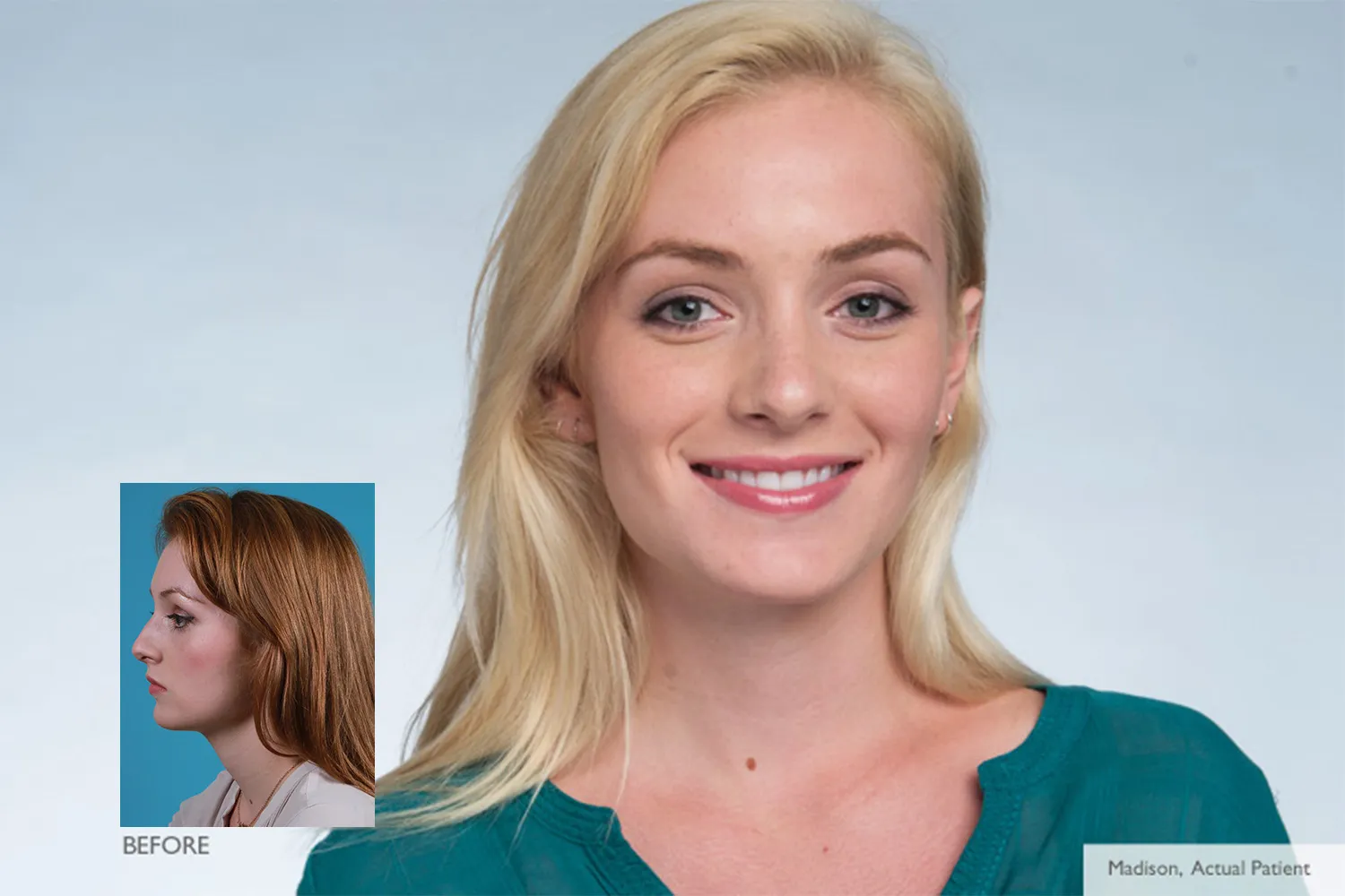 Before and After Rhinoplasty treatment | Rawnsley Plastic Surgery in Los Angeles, CA