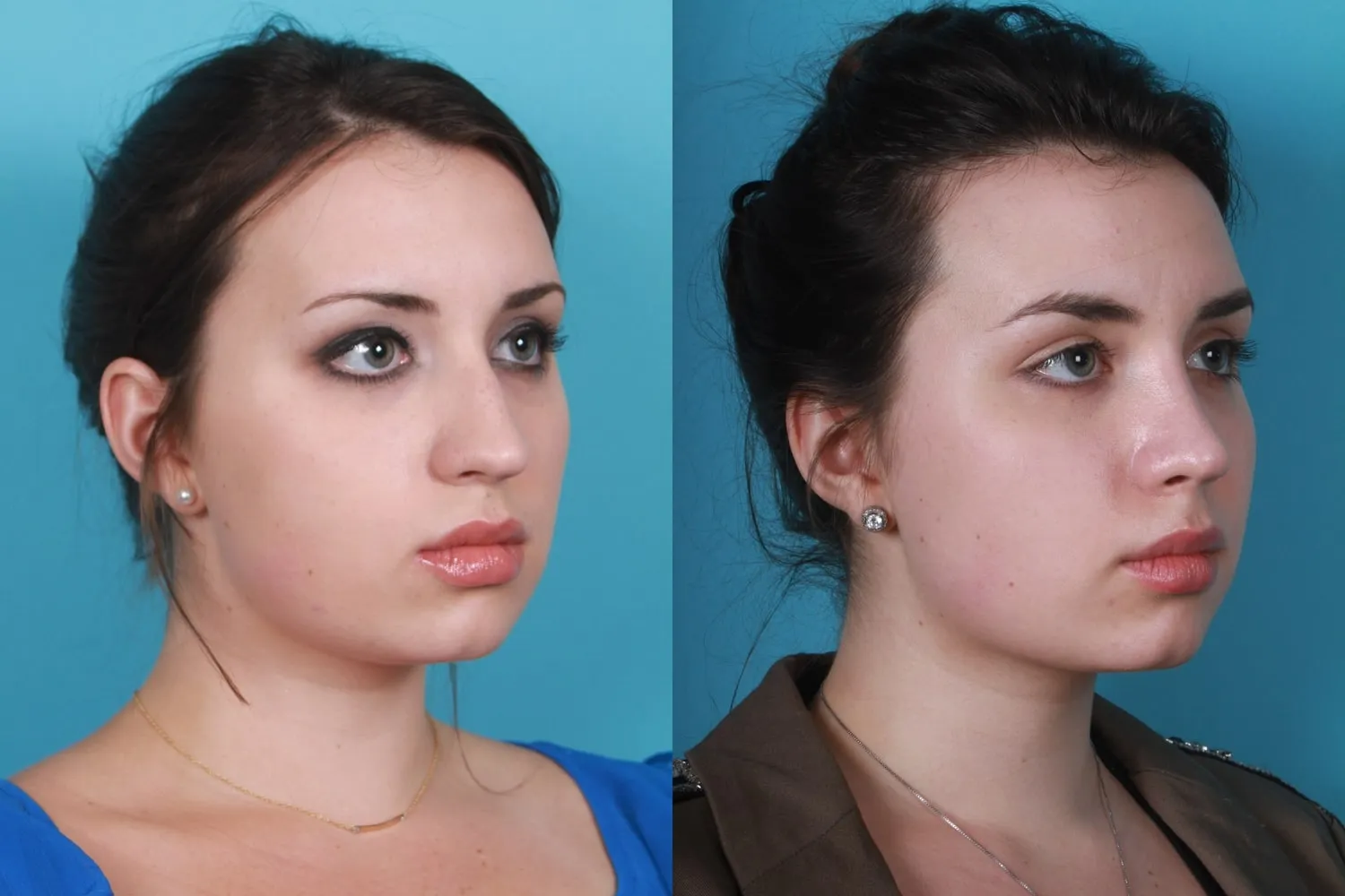 Before and After Primary Rhinoplasty treatment result of a woman | Rawnsley Plastic Surgery in Los Angeles, CA