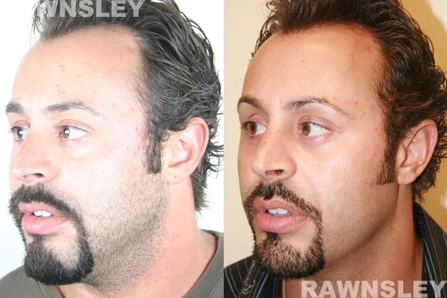 Before and After Ethnic Rhinoplasty treatment result of a man | Rawnsley Plastic Surgery in Los Angeles, CA