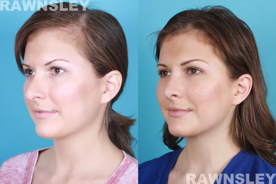 Before and After the result of Revision Rhinoplasty treatment | Rawnsley Plastic Surgery in Los Angeles, CA