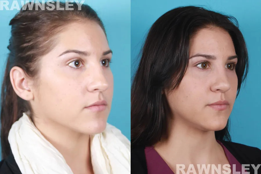 Before and After the result of Revision Rhinoplasty on Lady's nose | Rawnsley Plastic Surgery in Los Angeles, CA