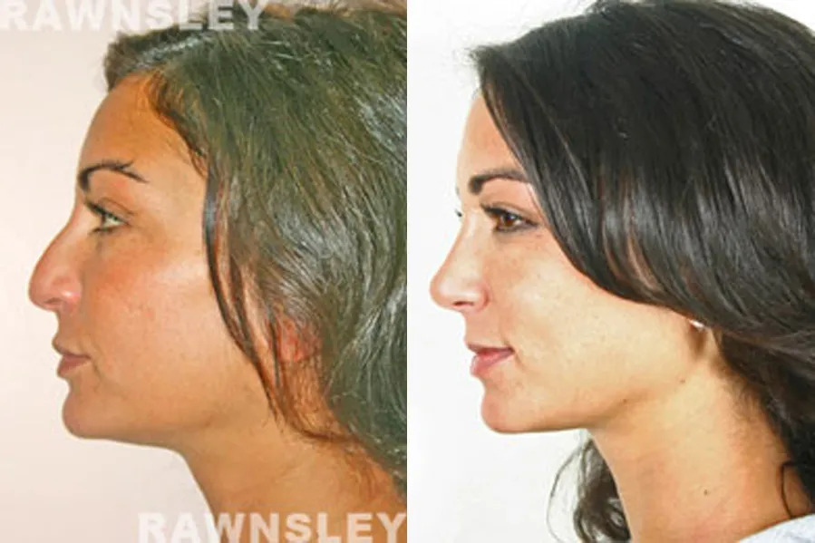 Before and After the result of Revision Rhinoplasty on a Woman | Rawnsley Plastic Surgery in Los Angeles, CA
