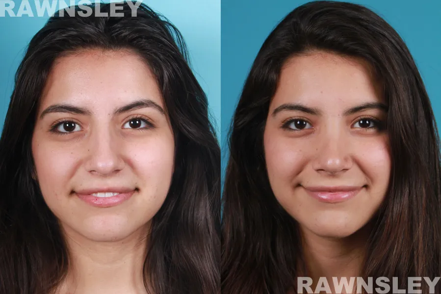 Before and After Revision Rhinoplasty treatment results on a lady | Rawnsley Plastic Surgery in Los Angeles, CA