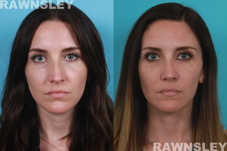 Revision Rhinoplasty treatment Before and After results of a lady | Rawnsley Plastic Surgery in Los Angeles, CA