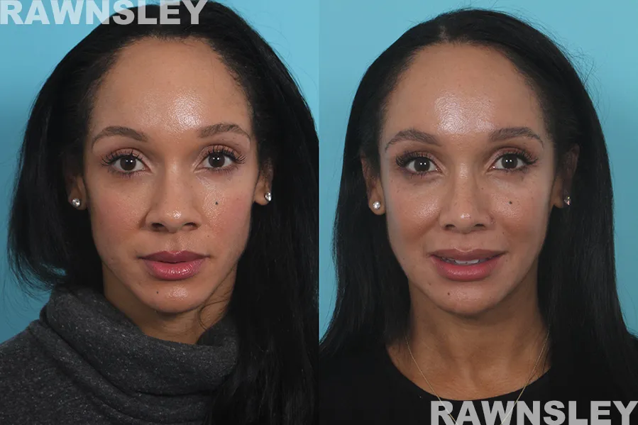 Before and After Revision Rhinoplasty treatment | Rawnsley Plastic Surgery in Los Angeles, CA