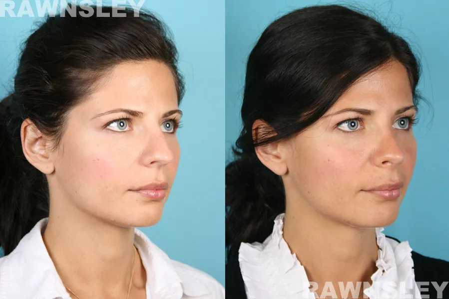rhinoplasty before and after b a
