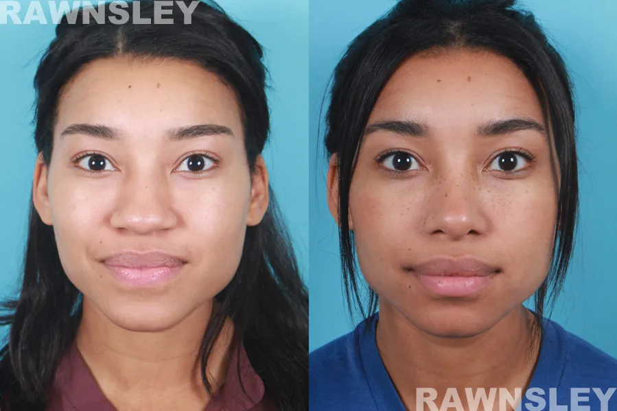 rhinoplasty before and after case one a