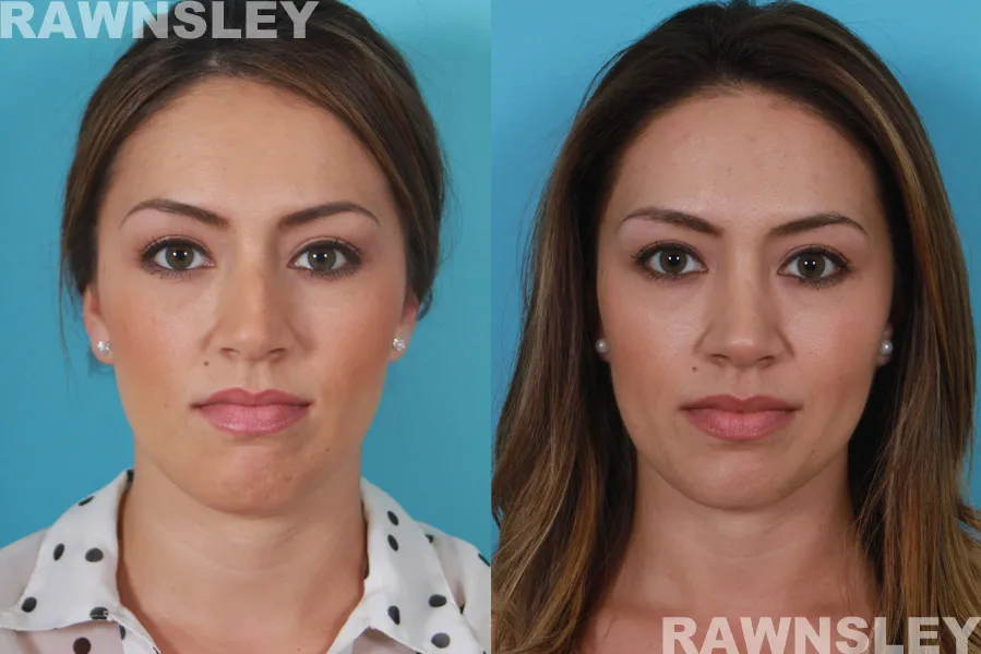Before and After Rhinoplasty treatment result of a woman | Rawnsley Plastic Surgery in Los Angeles, CA