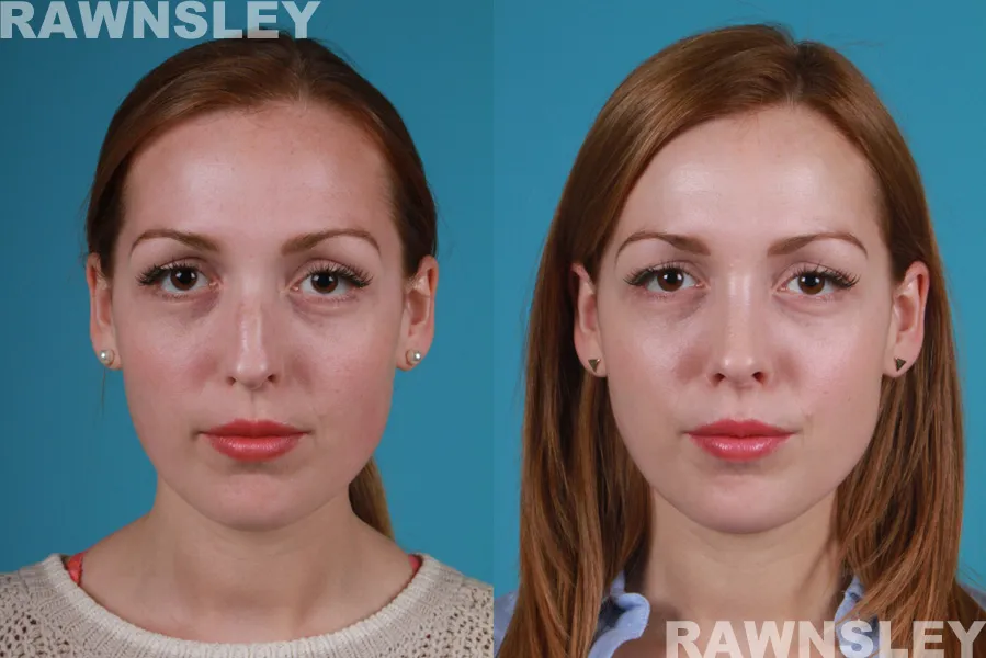 Before and After Rhinoplasty treatment result | Rawnsley Plastic Surgery in Los Angeles, CA