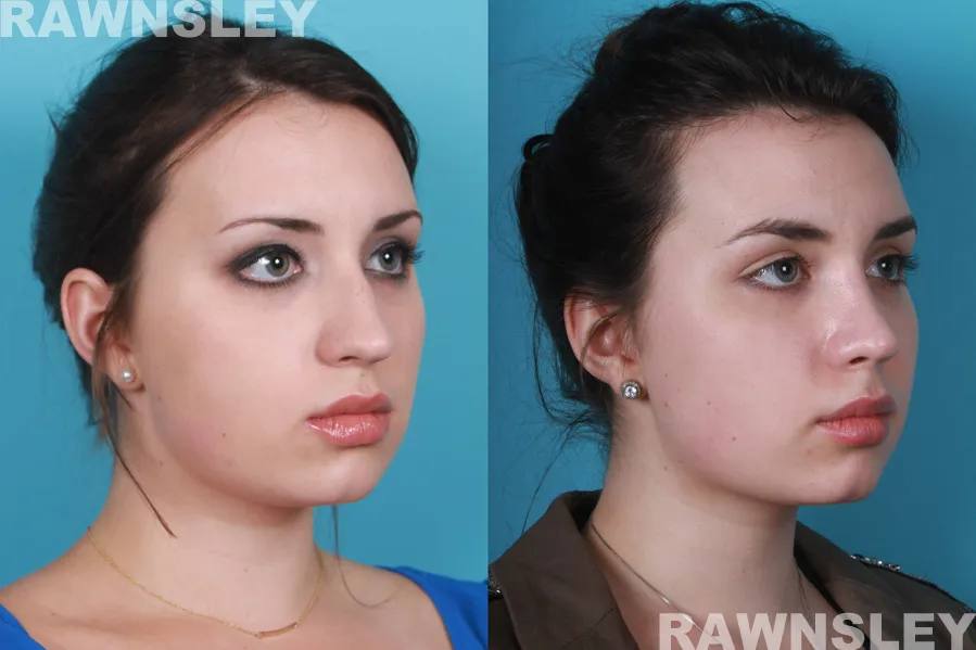 Before and After facetite treatment result of a woman | Rawnsley Plastic Surgery in Los Angeles, CA