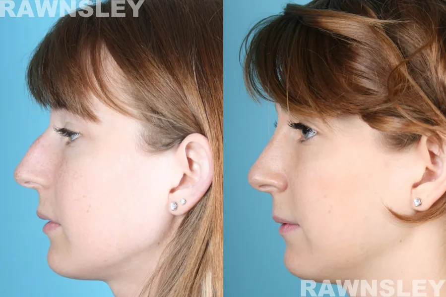 Rhinoplasty treatment Before and After results of a woman | Rawnsley Plastic Surgery in Los Angeles, CA