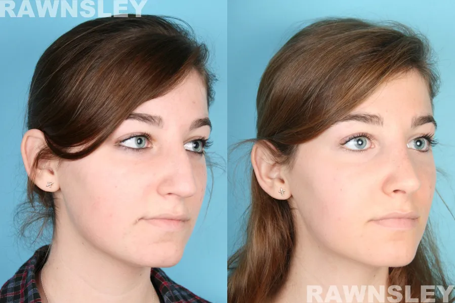 rhinoplasty before and after n a