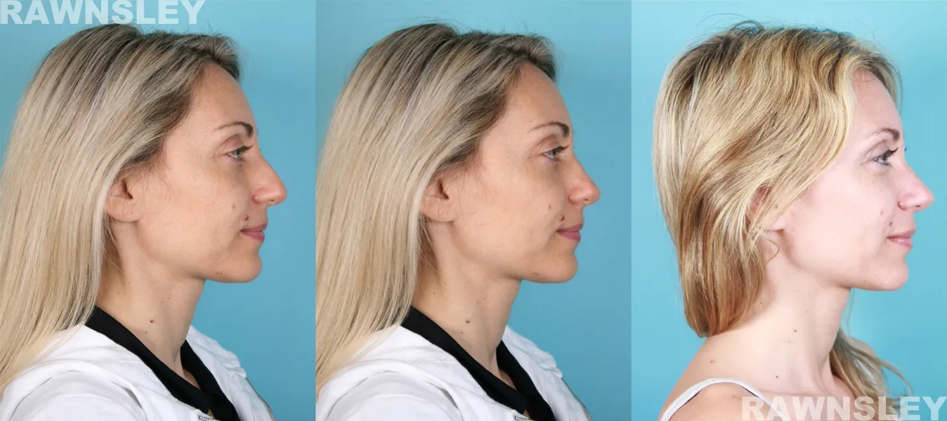 Revision Rhinoplasty treatment Before and After results of a lady | Rawnsley Plastic Surgery in Los Angeles, CA