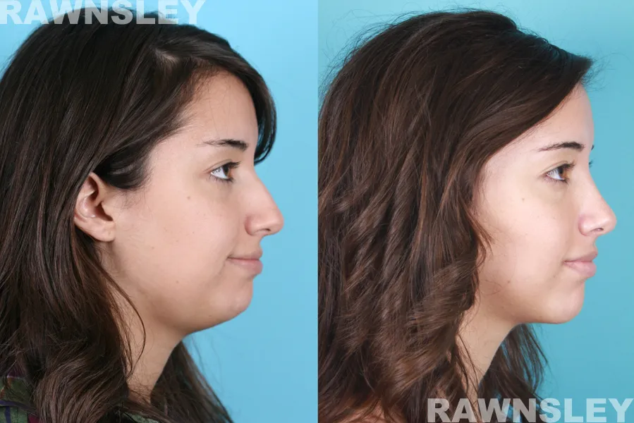 rhinoplasty before and after s a
