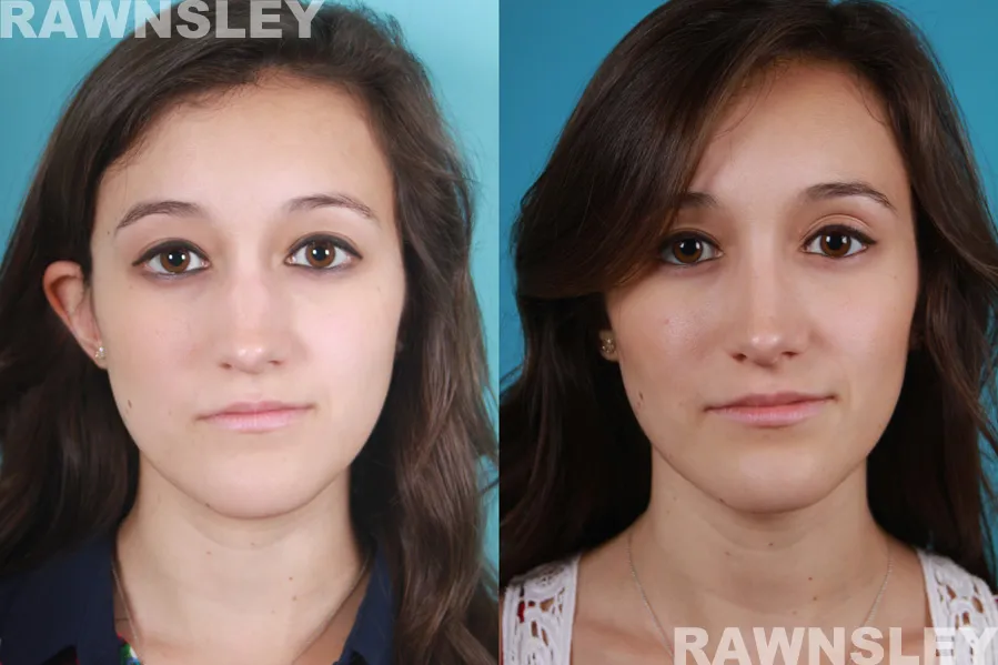 rhinoplasty before and after t a