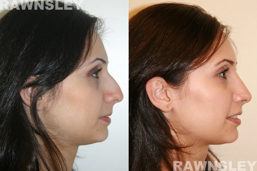 rhinoplasty before and after u a