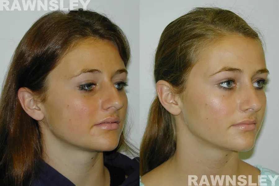 Before and After Revision Rhinoplasty treatment results | Rawnsley Plastic Surgery in Los Angeles, CA