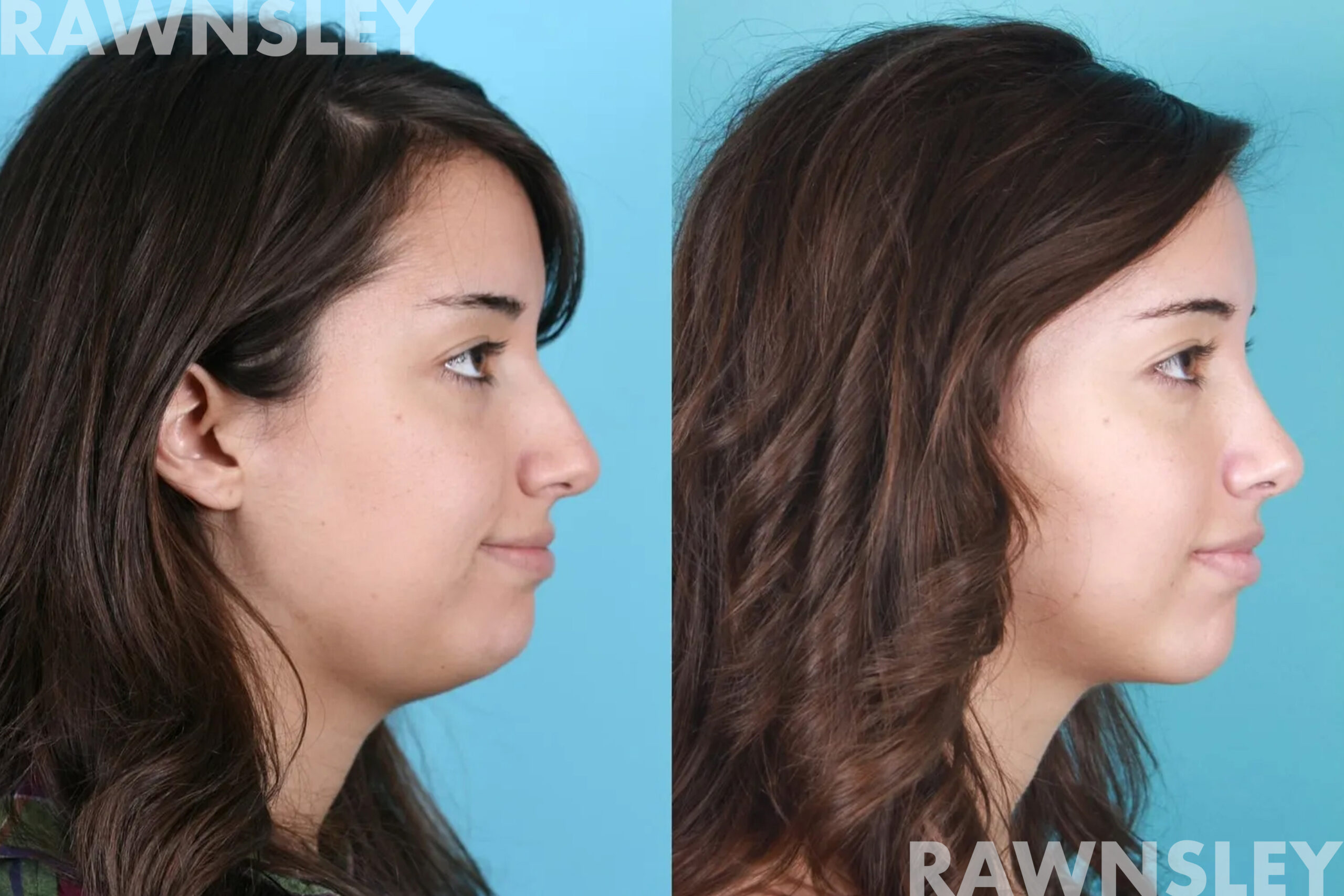 Patient profile view before and after submental liposuction, showing improved jawline definition