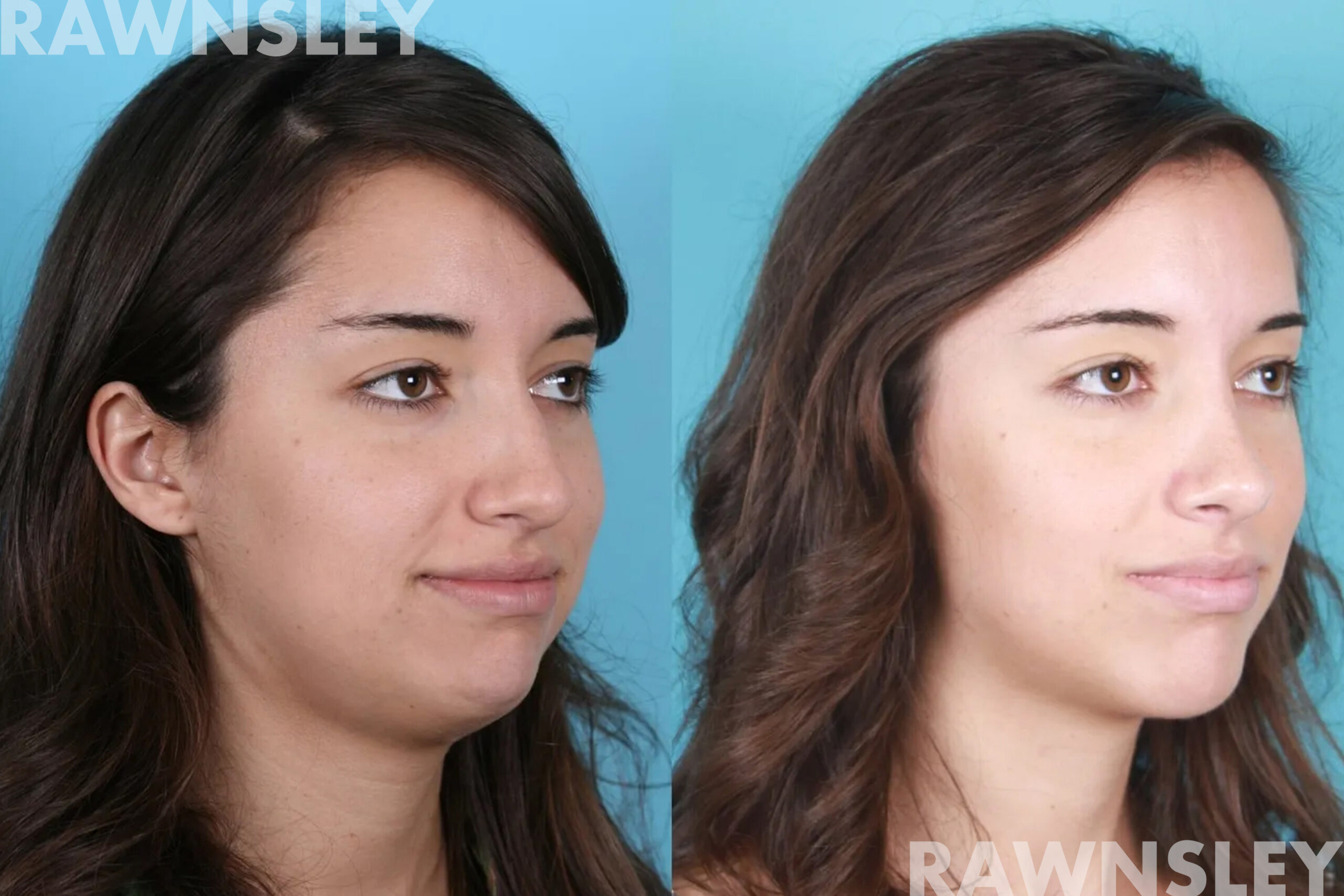 Patient before and after submental liposuction, profile view, showing a more defined jawline