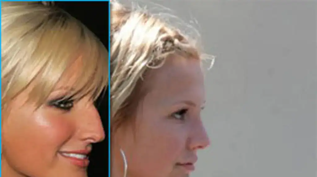 Ashlee Simpson before and after rhinoplasty nose surgery | Rawnsley Plastic Surgery in Los Angeles, CA