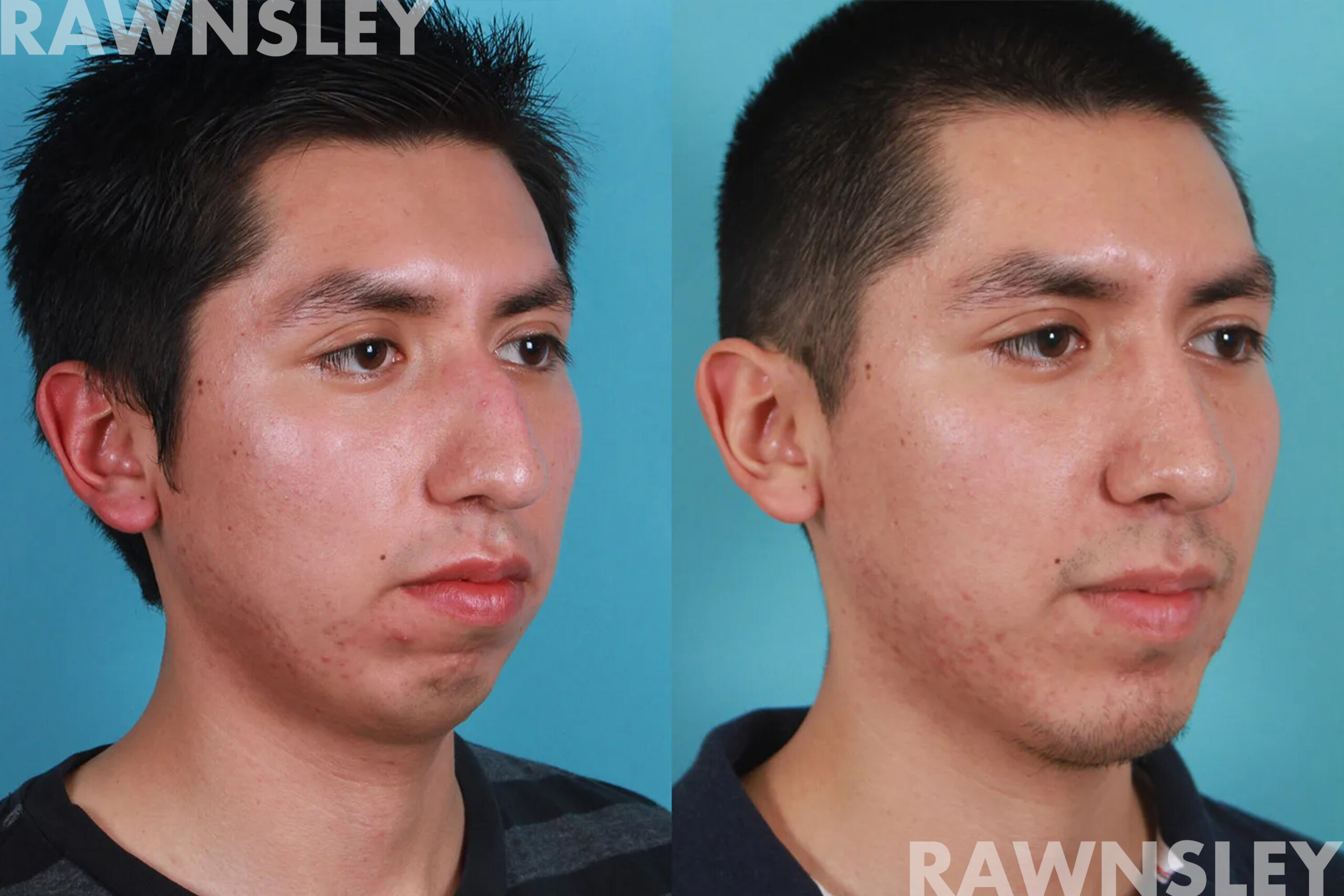 Patient profile view before and after rhinoplasty, chin, and lip augmentation