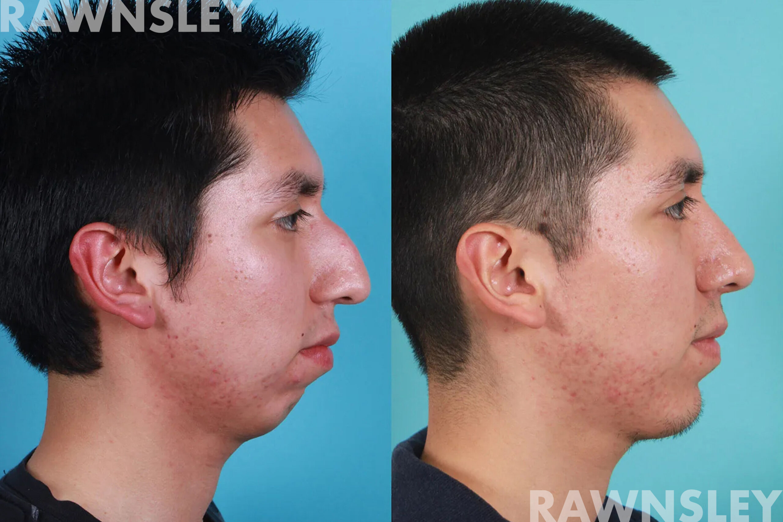 Patient profile view before and after rhinoplasty, chin, and lip augmentation
