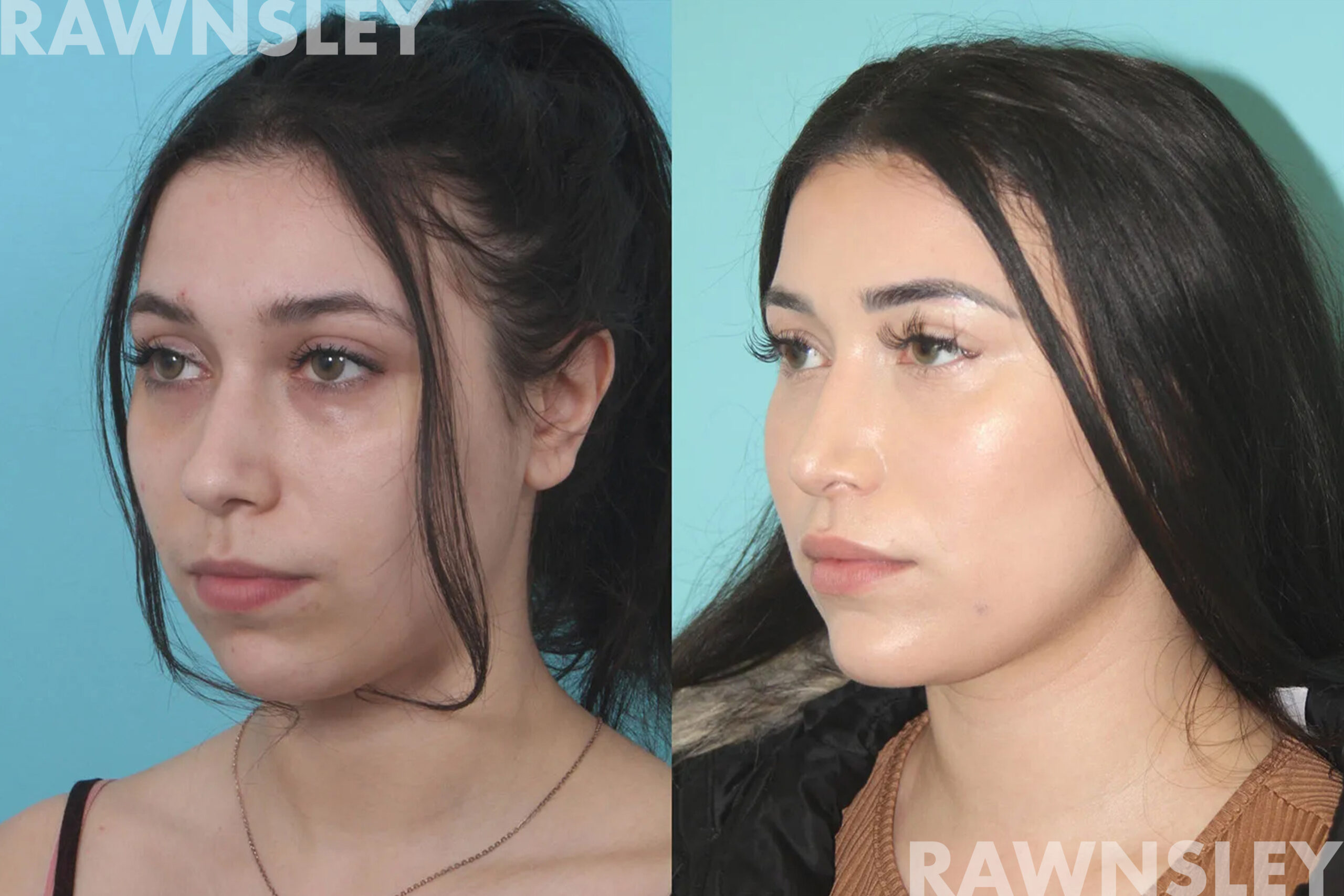 Patient before and after chin and lip augmentation, profile view