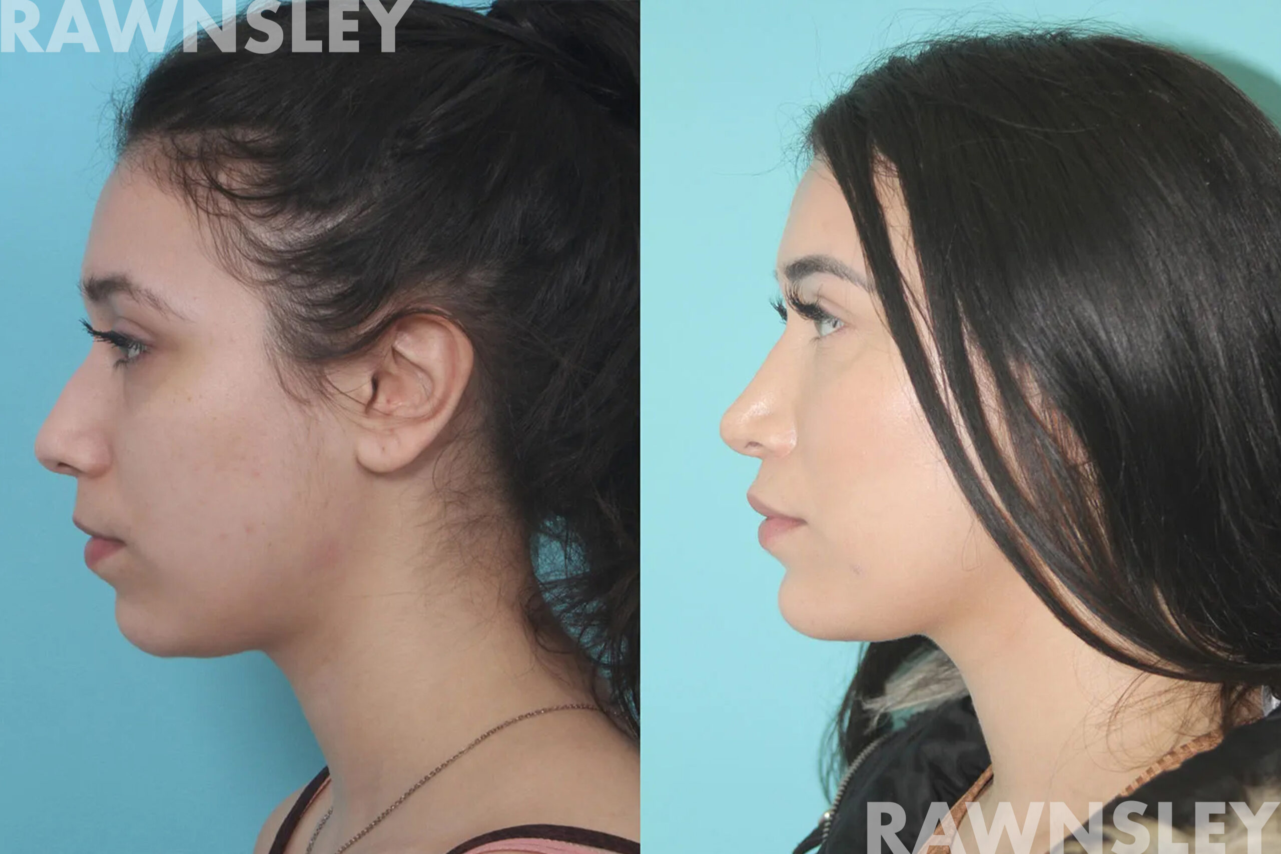 Patient profile view before and after chin and lip augmentation, showing improved chin projection and fuller lips