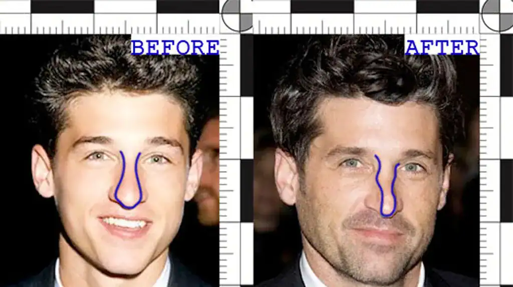 Patrick Dempsey’s before and after rhinoplasty | Rawnsley Plastic Surgery in Los Angeles, CA