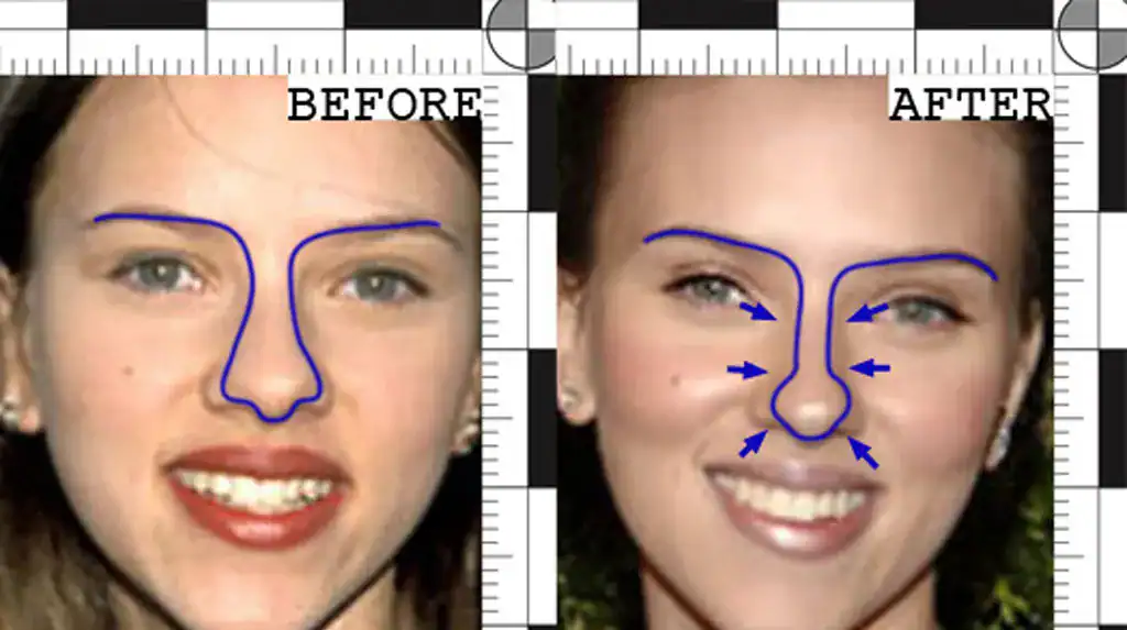 Scarlett Johansson’s before and after Nose treatment | Rawnsley Plastic Surgery in Los Angeles, CA